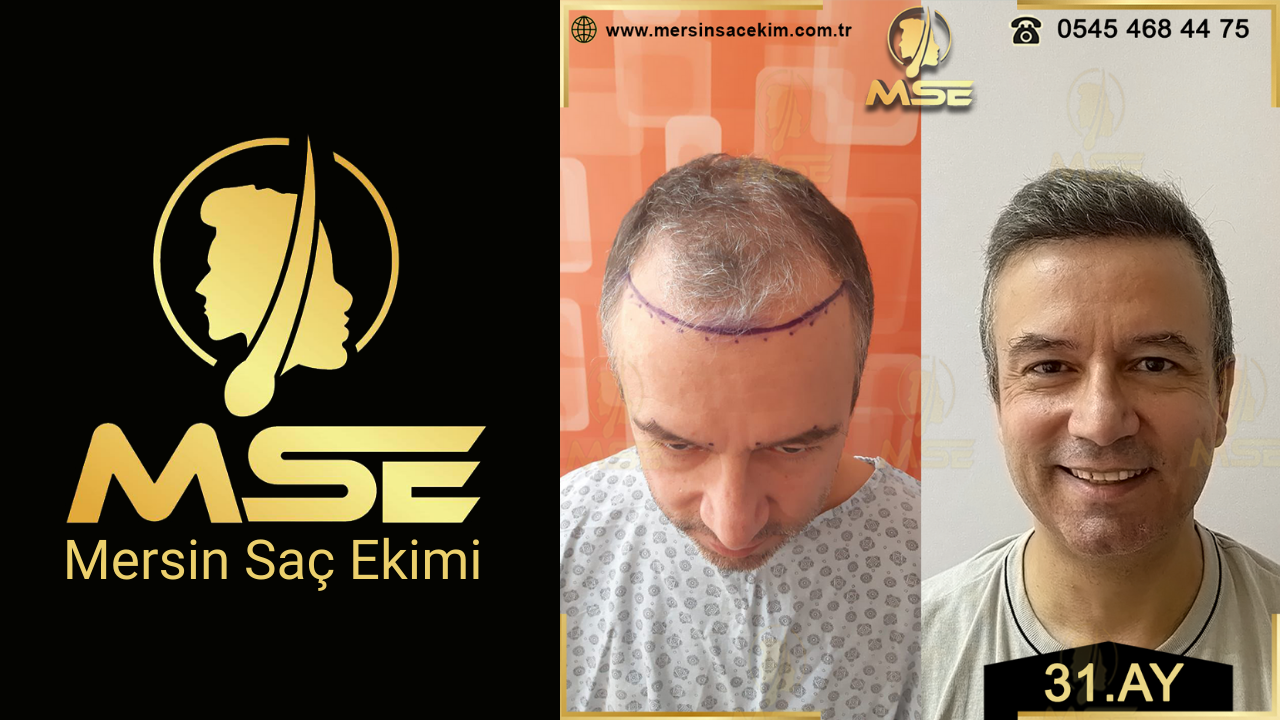 Mersin Saç Ekimi